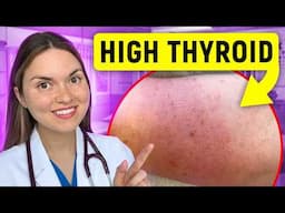 19 Signs of HYPERTHYROIDISM (Graves Disease) You Can See: Doctor Explains