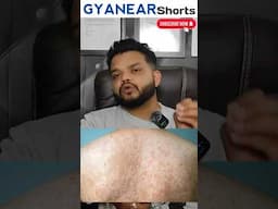 सेहुआ का इलाज 🔥 Tinea versicolor Shorts #gyanear #shorts