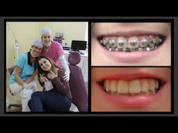 Brackets como se quitan - Paso a Paso