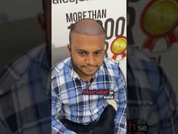 hair transplant price in Karachi  #alkhaleejclinics  #hairtransplantresults  #hairtransplantresults