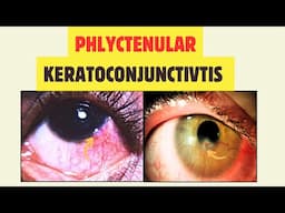 Phlyctenular Keratoconjunctivitis: Causes, Symptoms, Differentials & Treatment
