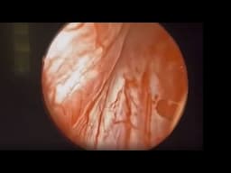 Case Report: 18-Months Post-aquablation With Recurrent UTIs