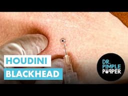Houdini Blackhead Vanishes Instantly – You Won’t Believe What Came Out! 😱🧼