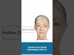 2 Main Factors of Facial Aging: Volume Loss, and Loose Skin #aging