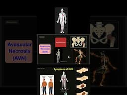 Avascular Necrosis AVN  #anatomy#health #bones