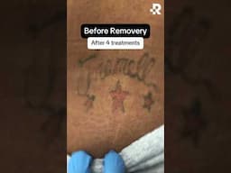 Tattoo removal transformation #removery #tattooremoval