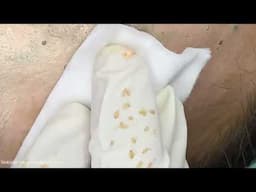 Big Cystic Acne Blackheads Extraction Blackheads & Milia, Whiteheads Removal Pimple Popping