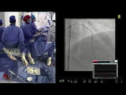 Live Case #6 - PCI of mid LAD and distal LAD CTO Bifurcation
