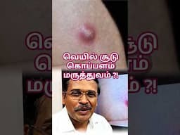 வீட்டு வைத்தியம் சூடு கொப்பளம் ?! #drkarthikeyan