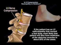 Sciatica or Pinched Nerve? How to Tell the Difference