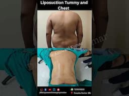 Liposuction 360° Abdomen and Chest