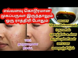 7 days darkspot removal challenge / Remove pimple Marks / home remedies pimple/rid of pimples