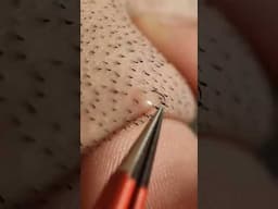 1 Minute Of Top ASMR Pimple Popping Video №98