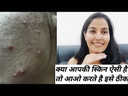 Day 2/30  अगर आपके भी चेहरा ऐसा है तो करते है इसे ठीक || चेहरे के मुंहासे ओर उसके गड्ढे #acnescars