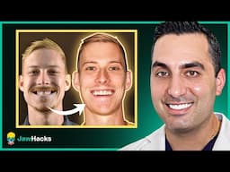 The MIND Procedure for Mid-Face Expansion (100% Success Rate)