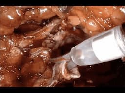 Case Report: 76-Year-Old Female Patient With History of Left Ureteropelvic Junction Obstruction