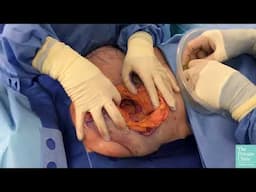 Removal of Implants & Uplift | 26 year old Implants Ruptured