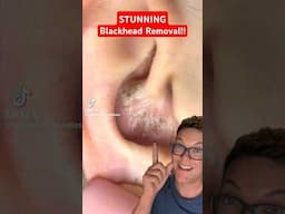 Greatest Ever EAR BLACKHEAD REMOVAL - Just WOW #shorts