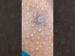 1 Minute Of Top ASMR Pimple Popping Video №105