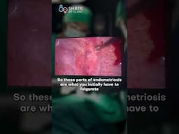 When Endometriosis Spreads to the Lungs: A Rare Case Explained! | Dr Jay Mehta, Mumbai