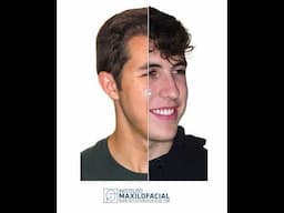 Correction of maxillary hypoplasia + mandibular asymmetry.