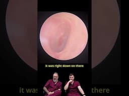 40 Years Without Wax Removal Leads to Major Hearing Issues!