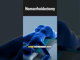 Hemorrhoid Surgery: Hemorrhoidectomy (3d animation) #hemorrhoids #medicalanimation
