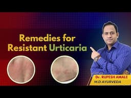 जिद्दी शीतपित्त का इलाज l 4 Step Process for Resistant Urticaria By Dr. Rupesh Amale