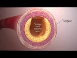 HOW TO PREVENT CLOGGED ARTERIES