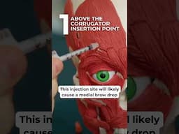 Injection points for frown lines