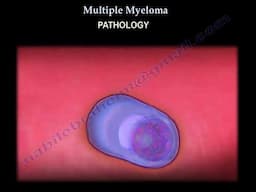 Multiple Myeloma Symptoms, Diagnosis, and Treatment