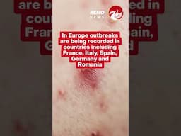 Measles warning to holidaymakers as outbreaks surge in major tourist hotspots