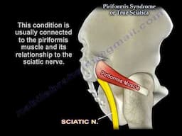 Piriformis Syndrome vs. Sciatica: Identifying the Actual Cause of Nerve irritation and  Pain