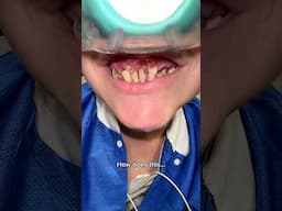 INCREDIBLE transformation! Holy S****! #transformation #smilemakeover
