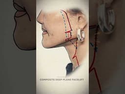 SMAS Facelift Explained | 2D Animation