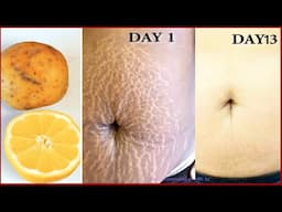 How to remove stretch marks permanently at home with potato juice / best remedy for stretch marks
