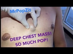 The deep chest bump flying pop! Very full deep sac completely removed. See follow up at end!