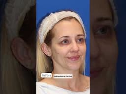 40 Year Old Woman Gets a Facelift...Her Results are STUNNING!