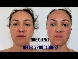 [14-MIN] LIFTING Massage for the whole face