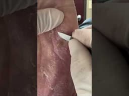 Deep, Flaky Foot Corn Extraction – Oddly Satisfying!  #satisfyingshorts #cornremoval