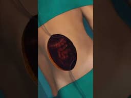 HIPEC (Heated Intraperitoneal chemotherapy) Procedure #medical3danimation