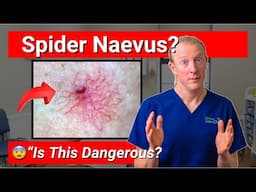 Spider Naevus or Something More Serious?
