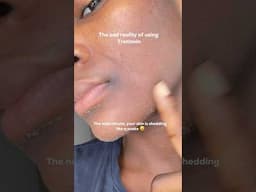 The sad reality of using Tretinoin #tretinoin #tretinoinjourney #shorts