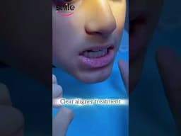 teeth aligners specialist in karachi #aligner #alignerorthodontics