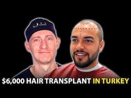 I Got a Hair Transplant in Turkey ($6,000) | Hair Surgeon Reacts