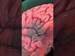 What is a brain hemorrhage: Brain bleed #medicalanimation