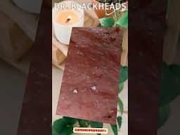 Blackheads Removal | Acne Treatment and Very Satisfying Satisfying Pimple pop #blackheads