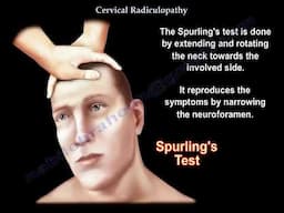 Cervical Radiculopathy Symptoms Diagnosis and Treatment