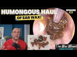 HUMONGOUS HAUL OF EAR WAX! Episode 465 (It's a shocker!)