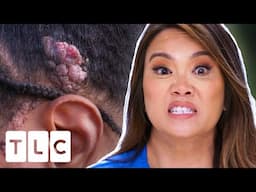 Dr. Lee Helps Patient With “WET AND SMELLY” Birthmark | Dr. Pimple Popper